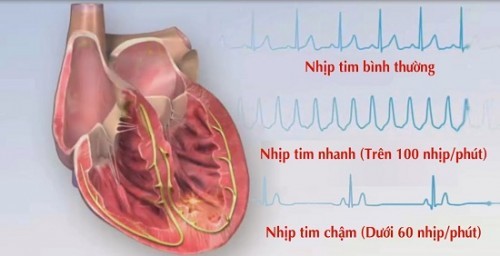 Nhịp tim ở người bình thường đập bao lần trên nhịp?