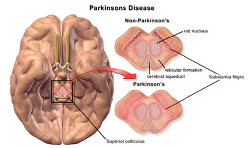 Bệnh Parkinson có những triệu chứng gì?