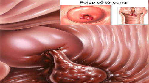 Bạn đã hiểu đúng về polyp cổ tử cung chưa?