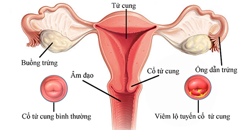Dấu hiệu nhận biết viêm lộ tuyến cổ tử cung là gì?