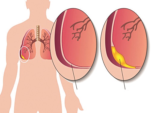 Nguyên nhân dẫn đến viêm màng phổi