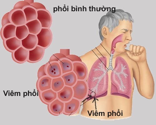 Dấu hiệu và nguyên nhân dẫn đến viêm màng phổi là gì?