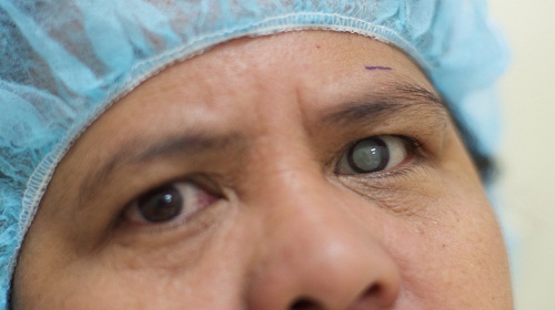 Các bệnh về mắt nguy hiểm thường gặp ở người già