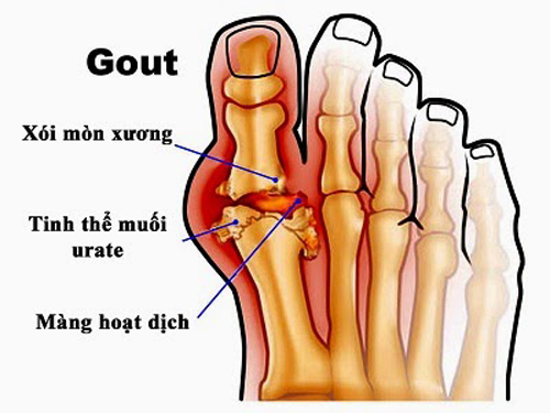 Bệnh Gout là bệnh gì?