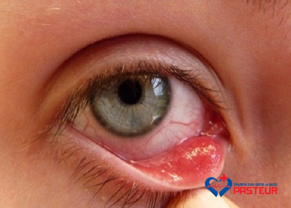 Bệnh đau mắt hột: Nguyên nhân, triệu chứng, phòng ngừa