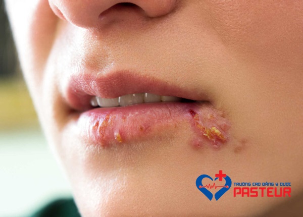 Bệnh herpes môi thường tự khỏi và có thể được điều trị tại nhà.