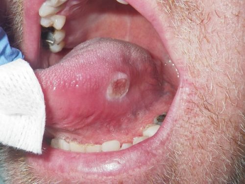 Dấu hiệu nào chứng tỏ bạn đang mắc bệnh ung thư lưỡi?