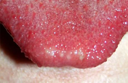 Những triệu chứng ở lưỡi đang tố cáo bệnh trong cơ thể