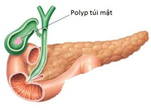 Bạn biết gì về bệnh Polyp túi mật?