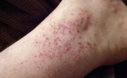 Một số bệnh thường gặp khi bị nổi mẩn đỏ ngứa ở tay và chân