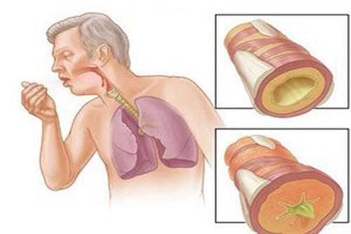 Bệnh lao phổi và cách điều trị