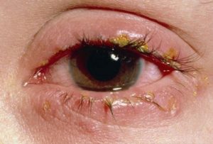 Triệu chứng của viêm kết mạc mắt