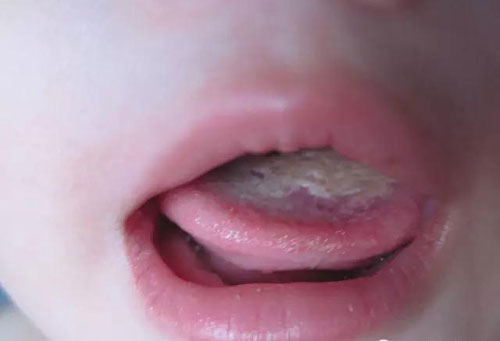 Điểm mặt một số bệnh nấm thường gặp ở trẻ nhỏ