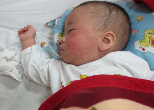 Cách phòng bệnh sởi cho trẻ sơ sinh dưới 9 tháng tuổi và trẻ mầm non