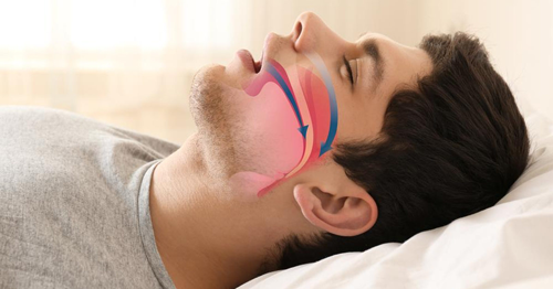Phương pháp điều trị cho bệnh nhân bị ngưng thở khi ngủ 