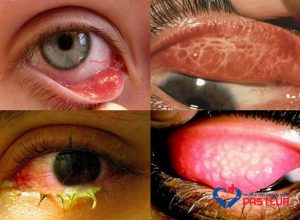 Triệu chứng đau mắt hột