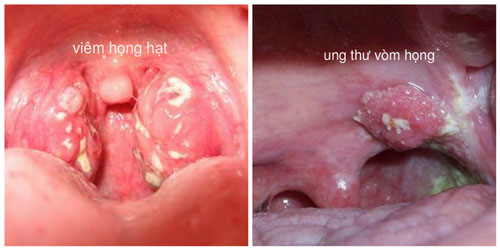Phân biệt viêm họng và ung thư vòm họng