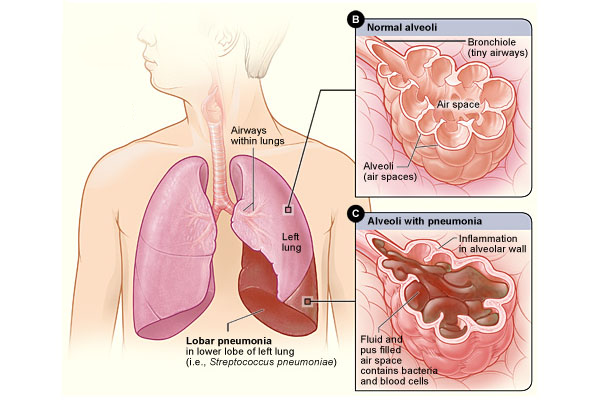 Triệu chứng bệnh viêm phổi