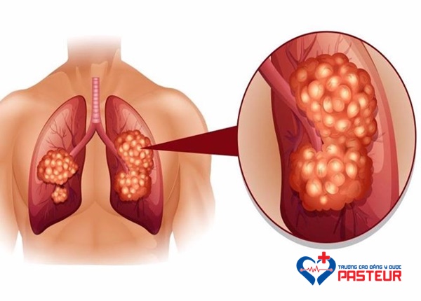 Bệnh ung thư phổi là gì?
