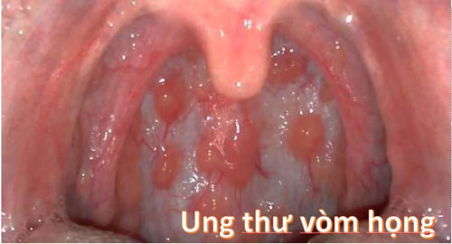 Ung thư vòm họng là bệnh gì?
