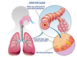 Tìm hiểu cách điều trị viêm phổi do phế cầu